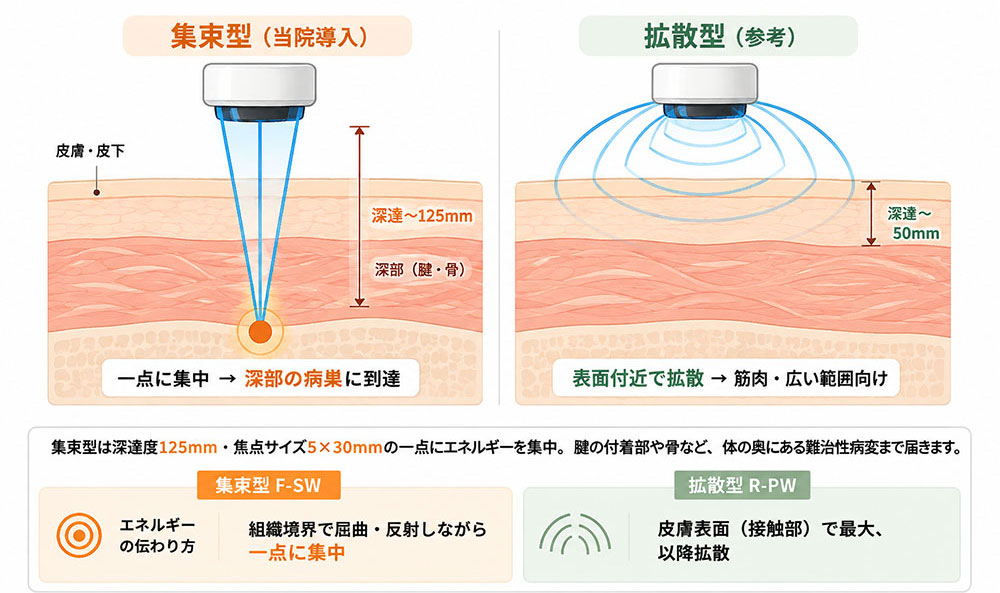 集束型(当院導入)、一点に集中 → 深部の病巣に到達。拡散型(参考)、表面付近で拡散 → 筋肉・広い範囲向け