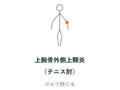 上腕骨外側上顆炎（テニス肘）、ゴルフ肘にも