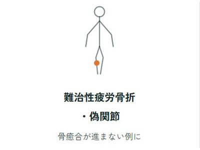 難治性疲労骨折・偽関節、骨癒合が進まない例に