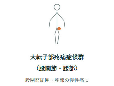 大転子部疼痛症候群（股関節・腰部）、股関節周囲・腰部の慢性痛に